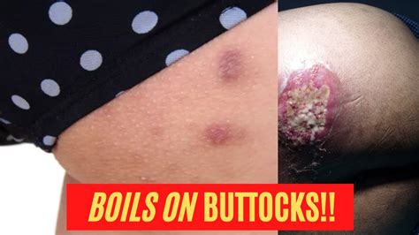 Boil popping on buttocks - A boil (furuncle) is a pus-filled bump in the skin that is caused by a bacterial infection. It’s a bit like a very big yellow pimple, but it’s deeper in the skin and hurts a lot more. Boils develop when a hair follicle and the surrounding tissue become infected. Hair follicles consist of one hair, the root of the hair, a sebaceous gland and ...